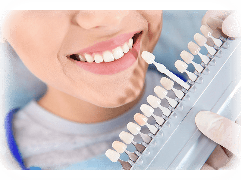 Dentist matching a teeth shade on a colour guide during whitening consultation