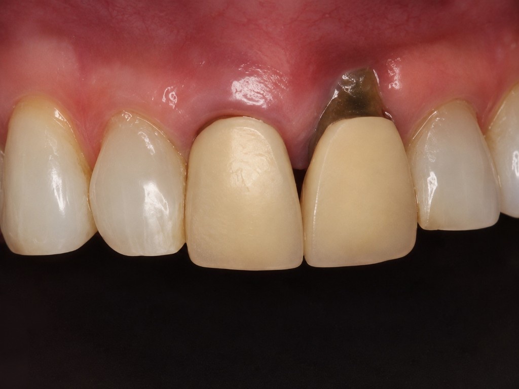 Before pinhole gum surgery near Cornwall: upper anterior teeth showing root exposure from gum recession