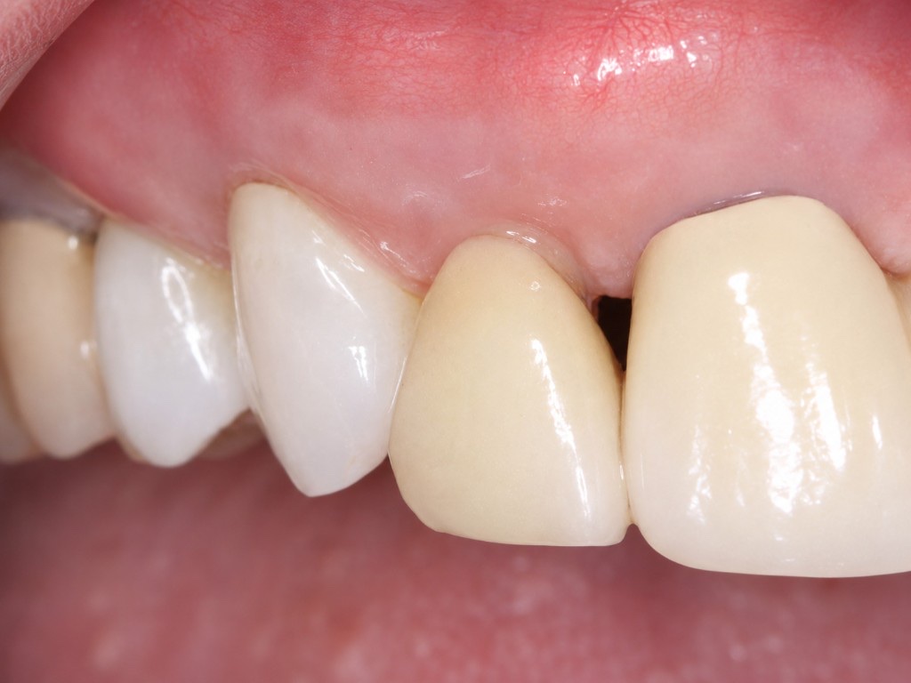 After Chao Pinhole gum recession treatment: healthy gum coverage restored along the upper dental arch