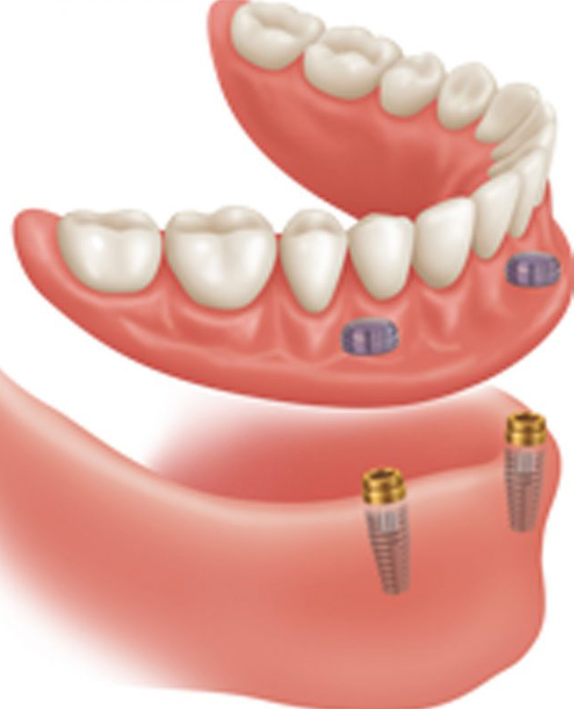 implant supported dentures at Cornwall dental arts in Cornwall, ON