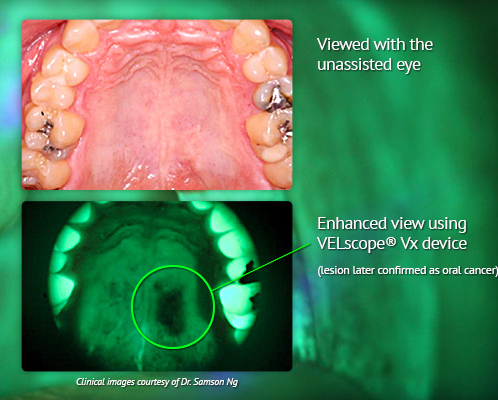 oral cancer screening at Cornwall dental office in Cornwall, ON