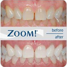 zoom teeth whitening at Cornwall dental office in Cornwall, ON